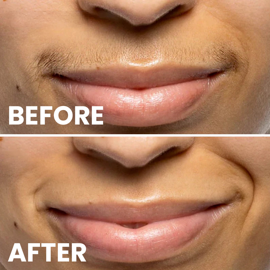 5MINSKIN AT-HOME LASER HAIR REMOVAL HANDSET - 72% OFF CHRISTMAS SALE + 4 FREE GIFTS (WORTH $290)